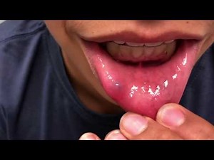 Popping a Lip Cyst? Mucocele: Causes, Symptoms, and Treatment (Extended)