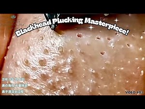 Insanely Satisfying Sebaceous Filament Removal | Blackhead Plucking | 鼻角栓 제거 | 鼻角栓 ピンセット | 粉刺清除 |03