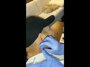 Biggest neck pimple explosion