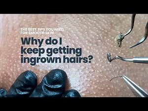 Why do I keep getting ingrown hairs? Say no to Razor Bumps, Irritation and Dark Spots!