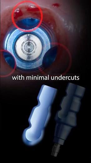 CLOSED Tray IMPLANT Impression Coping Technique #dentalshorts