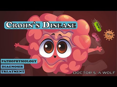 Crohn’s disease: Etiology, Pathophysiology, Clinical Features,Treatment