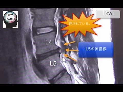 腰椎ヘルニアのMRI画像診断【画像診断チャンネル】