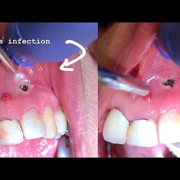Worm 🐛 Holes in the mouth