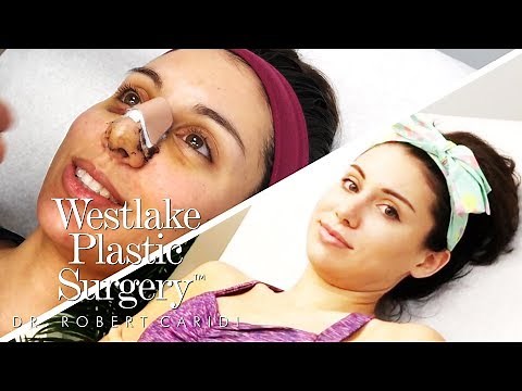 The Rhinoplasty Experience | Before and After
