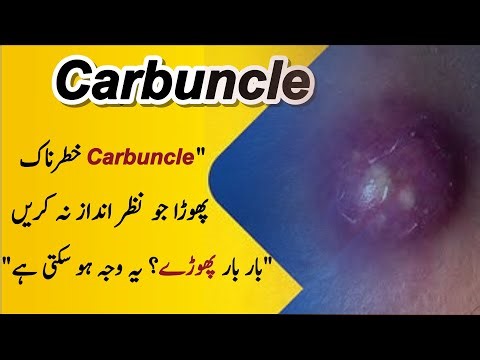 Carbuncle Kya Hai? | Khatarnaak Phora Jo Nazar Andaaz Na Karein