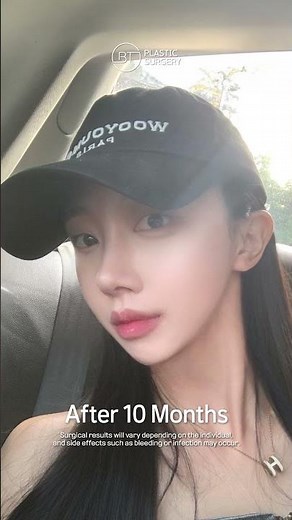 Facial Contouring Surgery Before and After in Korea Plastic Surgery Clinic #koreanplasticsurgery
