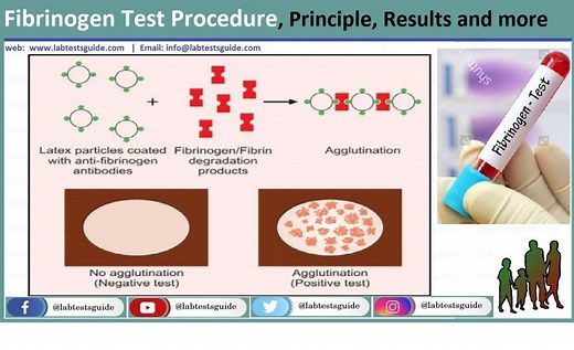 Fibrinogen Test Procedure | Lab Tests Guide