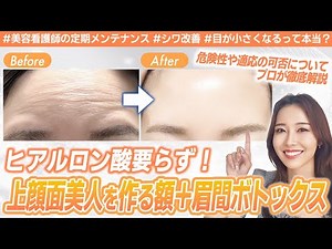 [Forehead and glabella Botox in detail] A beauty nurse treatment report. Botox makes your eyes sm...