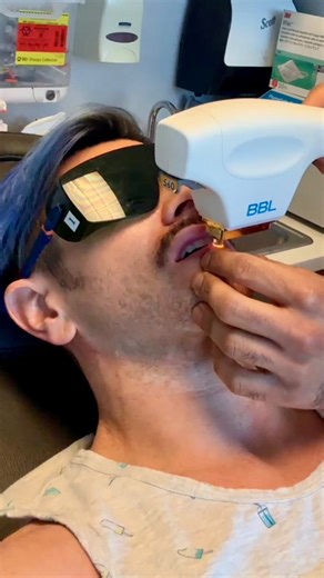 Brian Friedman on Instagram: "I got BBL and it’s not the one you think 🍑 On Episode 5 of Build-a-bit€h-workshop, I wanted to get rid of a Venous Lake on my lip so my Fairy Godfather @sirdermzalot suggested BBL (BroadBand Light) which uses intense pulsed light (IPL), not a laser, to target problem. He said it wouldn’t hurt but it was a little ELECTRIC ⚡️ The good news is, it’s gone! 😃 These are all FILTER FREE content which is hard for me to do but I want to share my authentic journey with you 