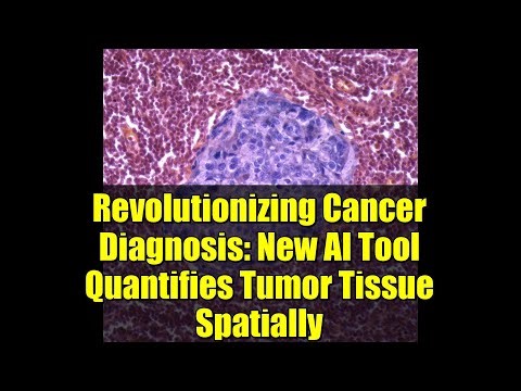 Revolutionizing Cancer Diagnosis: New AI Tool Quantifies Tumor Tissue Spatially