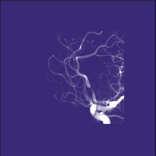 MRA and Flow MRI: Time-of-flight MRA | e-MRI