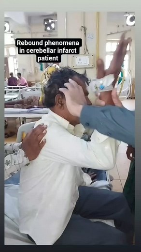 Neurology physical examination on Instagram: "Rebound Phenomenon (also called Holmes Rebound Phenomenon) is a classic cerebellar sign seen in patients with cerebellar lesions—especially involving the spinocerebellum. --- Definition It is the inability to stop a movement after an external resistance is suddenly removed, due to loss of normal "check" reflex (braking mechanism) of muscles. --- Normal Physiology When you push against a resistance (e.g., your arm flexes against the examiner’s hand), 