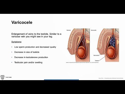 Varicocele Overview & Treatment