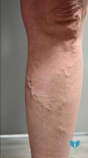 What to Expect During and After a VenaSeal™ Procedure for Varicose Vein Treatment