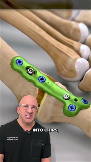 How Surgeons Grind-up Donor Bone to Heal Fractures #orthopedics