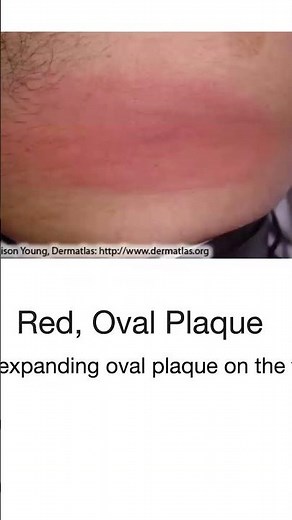 This is what the Lyme disease Rash Looks Like!