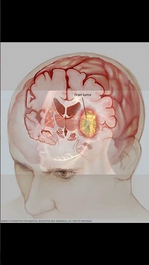 What is the most common cause of optic nerve damage ?