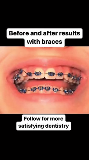 Before and after results in 10 seconds, Dental braces (also known as braces, orthodontic cases, or cases) are devices used in orthodontics that align and straighten teeth and help position them with regard to a person’s bite, while also aiming to improve dental health. They are often used to correct underbites, as well as malocclusions, overbites, open bites, gaps, deep bites, cross bites, crooked teeth, and various other flaws of the teeth and jaw. Braces can be either cosmetic or structural. D