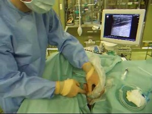 超音波ガイド下内頚静脈穿刺 ultrasound guided central venous catherter