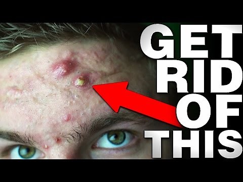 EXACTLY What To Do With A BIG Zit or Cyst! (From Experience)