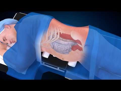 Medtronic: OLIF25 Procedure (Spine Animation)