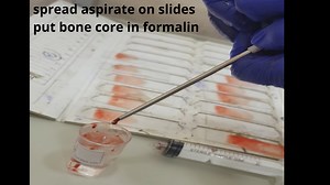 bone marrow aspiration and biopsy procedure