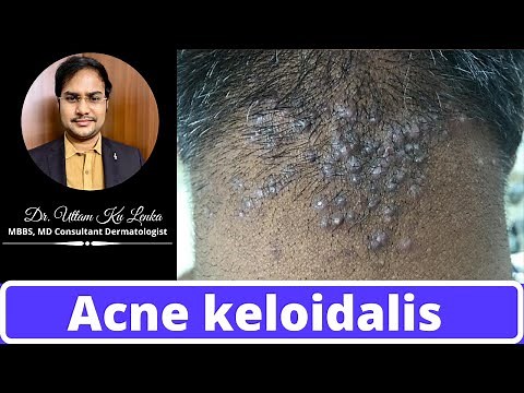 Reason and Treatment of pimples on neck/back side of head(Acne keloidalis) | By MBBS Dr Uttam Lenka