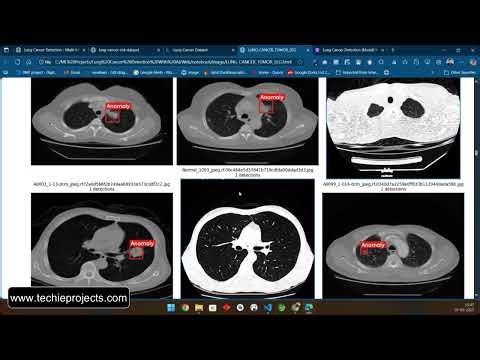 Lung Cancer Detection using Deep Learning | Machine Learning Projects for Final Year CSE