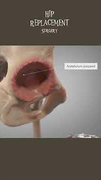 Hip replacement surgery 3D animation short video || #surgery #video