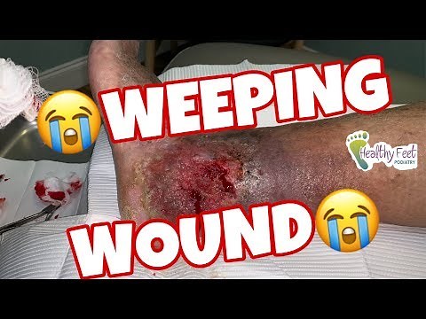 Weeping Wound