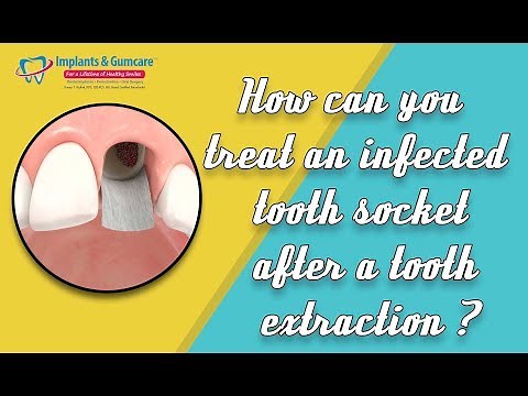 How can you treat an infected tooth socket after a tooth extraction? - by Dr Vadivel, Carrollton, TX