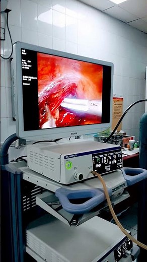 laparoscopic Varicocele Ligation surgery part 1