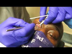 A Stye Meets its Match