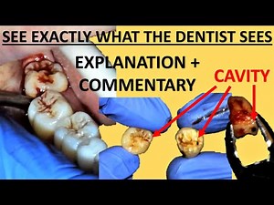 Upper and Lower Right Wisdom Tooth Removal (Extraction) - Full Surgery Walkthrough • Video • MEDtube.net
