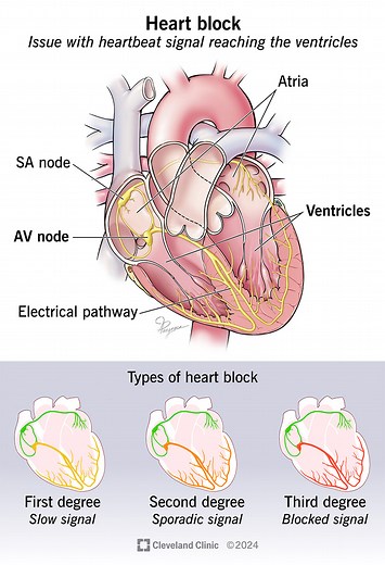 Do You Know the Symptoms of Heart Block?