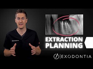 How To Extract Teeth Successfully Every Time | OnlineExodontia.com