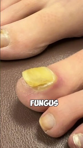 How to Remove Toenail Fungus 😷🩺🩻