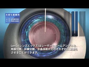最先端の白内障手術・レーザー白内障手術を徹底解説 大宮七里眼科