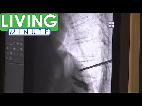 Using Bone Cement to Fix Fractured Vertebrae | Living Minute