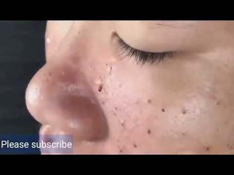 blackheads extraction and removal videos 2021 #011