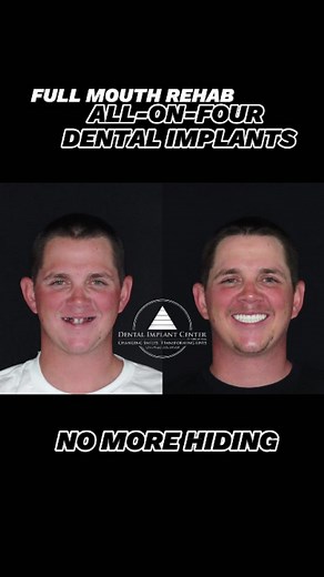 Final teeth seated today! A few of many benefits of all-on-four dental implants: • Restore confidence in eating and smiling • Eliminate health issues associated with failing teeth • A better long-term solution compared to dentures Changing smiles. Transforming lives. Complimentary Consultation (918) 906-2525 #TransformationTuesday #dentalimplants #smilemakeover #AllOnFour #allon4 #FullMouthRestoration #fullmouthrehabilitation #fullmouthimplants #tulsa #Oklahoma #boardcertified #fourstrong #newsm