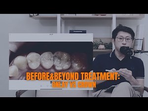 Onlay vs Crown: Understanding the Differences and Benefits | BEFORE & BEYOND EP35