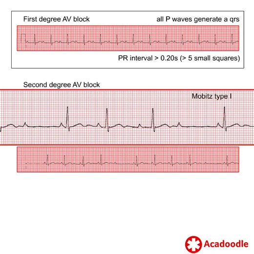 How to Recognize AV Block - Some Quick Tips - Find out more at https://acadoodle.com #emergencymedicine #intensivecare #respiratory #respiratorycare #icu #nurses #icunurse #ecg #ekg #cme #cmeonline | Acadoodle