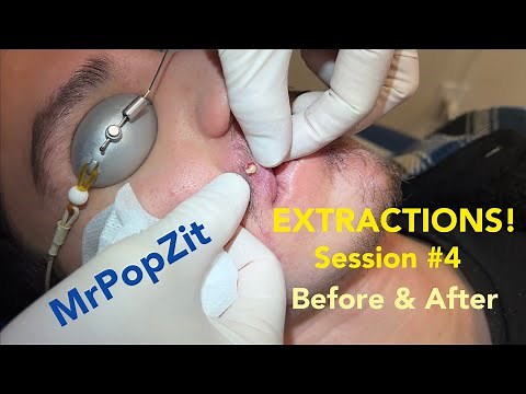 Severe Acne extractions. Session 4, amazing before and after! So many pops!