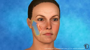 Facelift Surgery