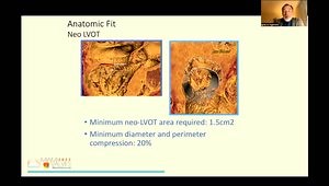 Investigational TMVR-2: The Intrepid Valve