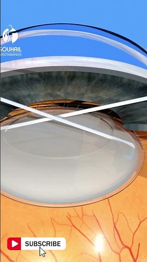 Cataract Explained : Everything you need to know