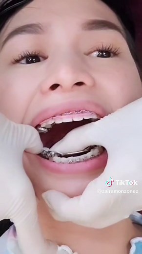 Herbst Appliance Installation: Orthodontic Procedure Explained