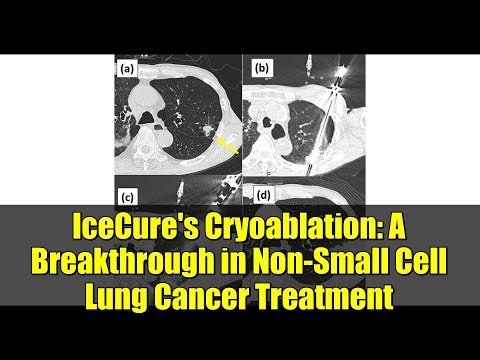 IceCure's Cryoablation: A Breakthrough in Non-Small Cell Lung Cancer Treatment